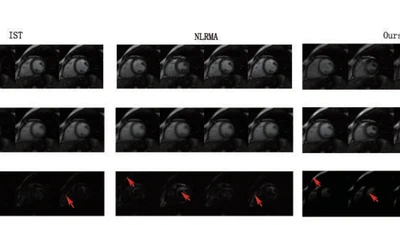 A Fast Low-Rank Matrix Factorization Method for Dynamic Magnetic Resonance Imaging Restoration featured image